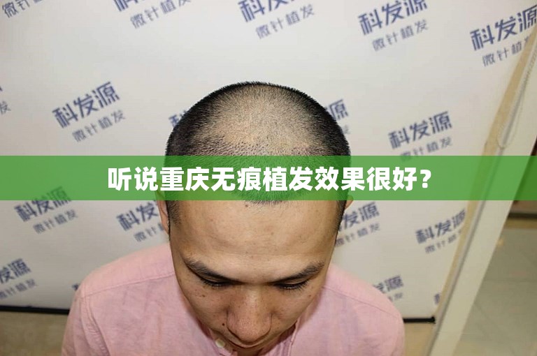 听说重庆无痕植发效果很好？