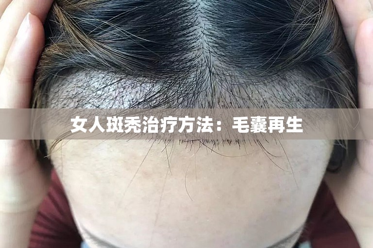 女人斑秃治疗方法：毛囊再生