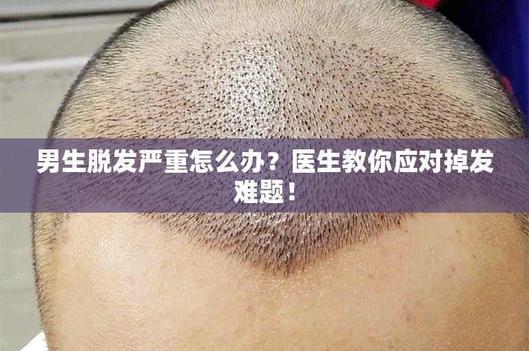 男生脱发严重怎么办？医生教你应对掉发难题！