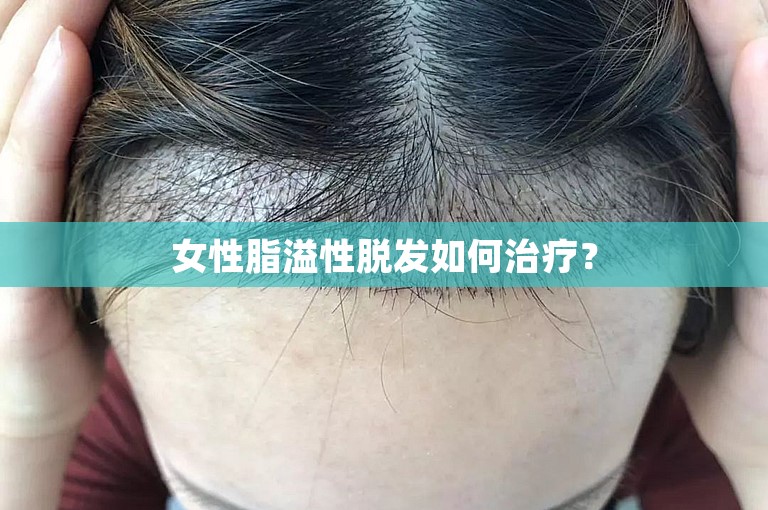 女性脂溢性脱发如何治疗？