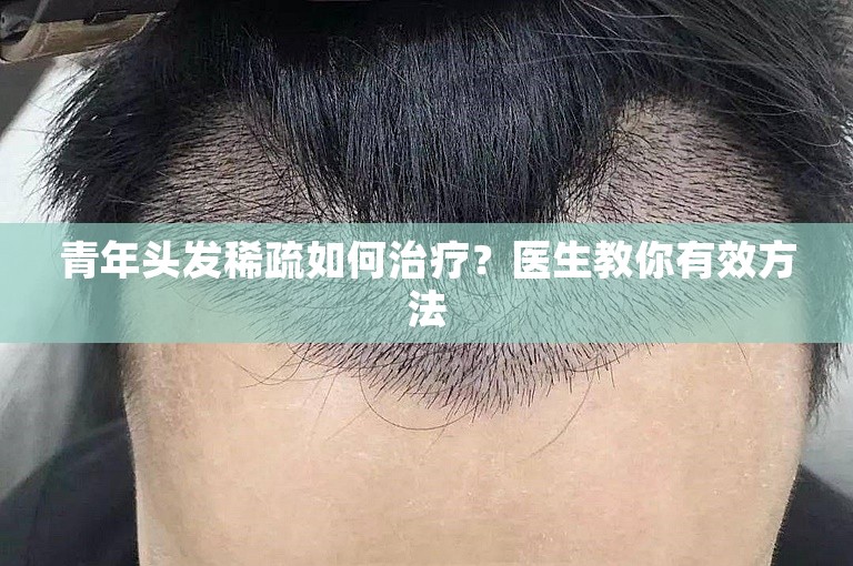 青年头发稀疏如何治疗？医生教你有效方法