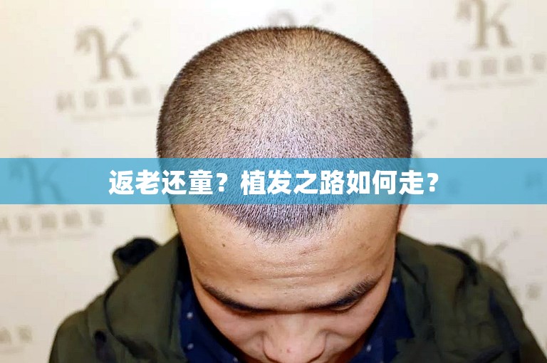 返老还童？植发之路如何走？