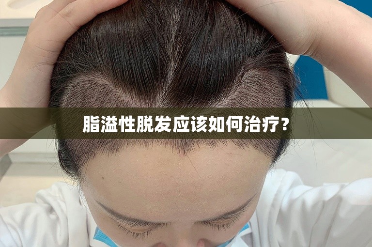 脂溢性脱发应该如何治疗？