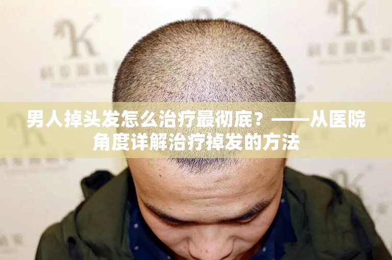 男人掉头发怎么治疗最彻底？——从医院角度详解治疗掉发的方法