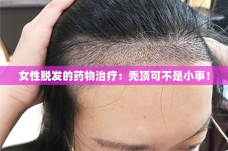 女性脱发的药物治疗：秃顶可不是小事！