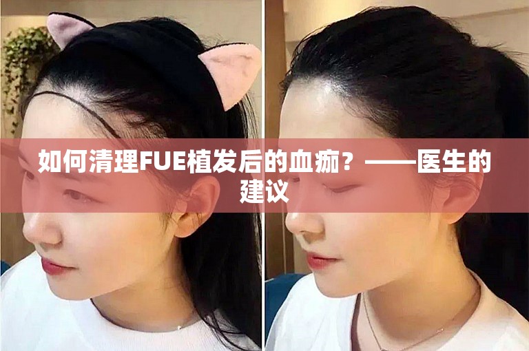 如何清理FUE植发后的血痂？——医生的建议