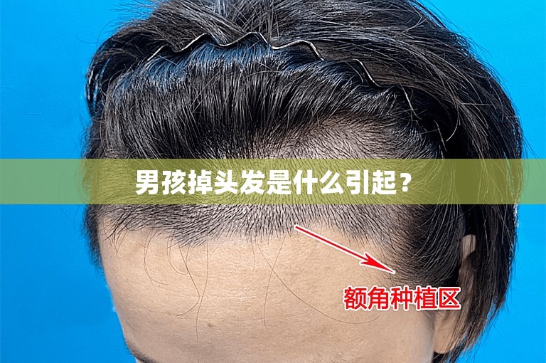 男孩掉头发是什么引起？