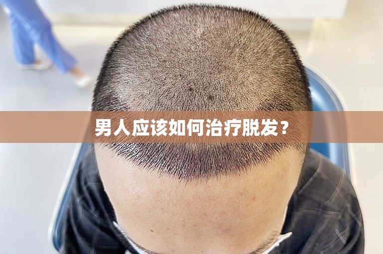 男人应该如何治疗脱发？