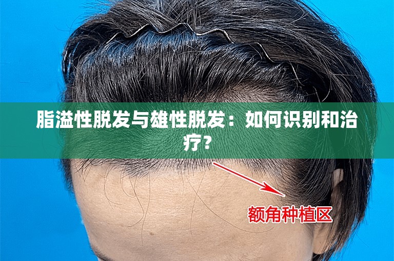 脂溢性脱发与雄性脱发：如何识别和治疗？