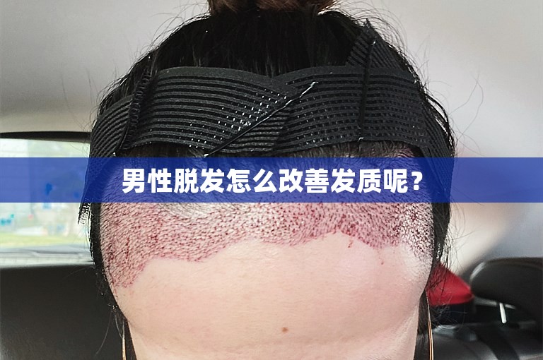 男性脱发怎么改善发质呢？