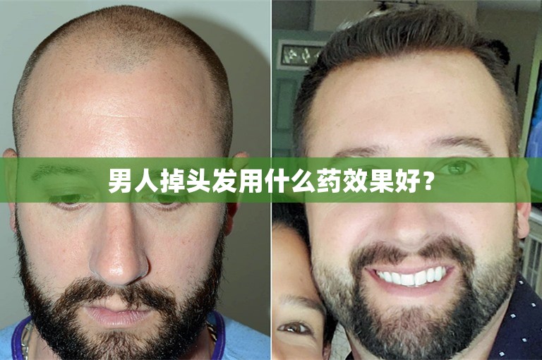 男人掉头发用什么药效果好？