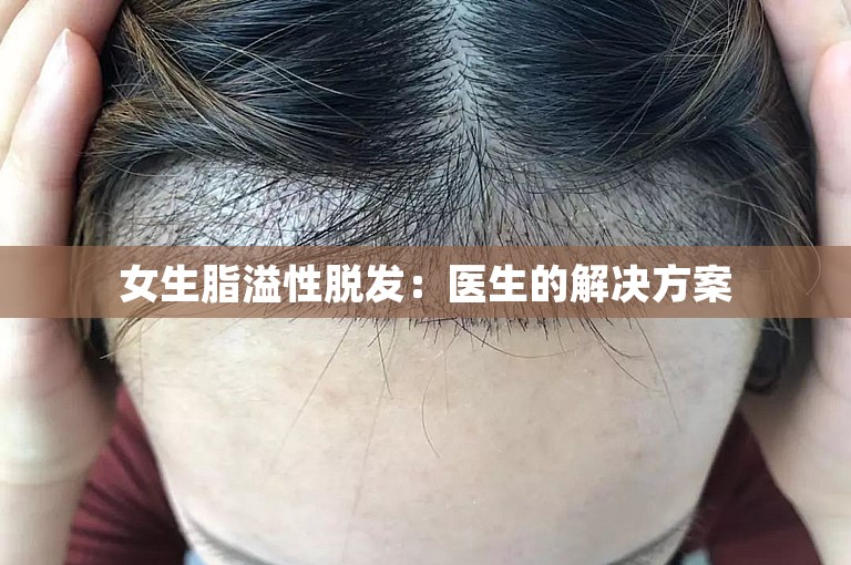 女生脂溢性脱发：医生的解决方案