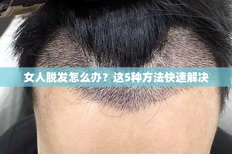 女人脱发怎么办？这5种方法快速解决