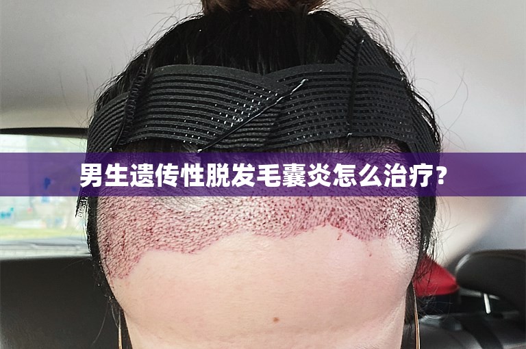 男生遗传性脱发毛囊炎怎么治疗？