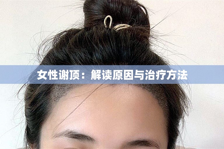 女性谢顶：解读原因与治疗方法