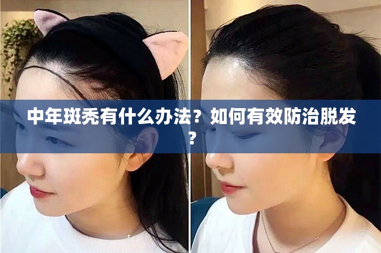 中年斑秃有什么办法？如何有效防治脱发？