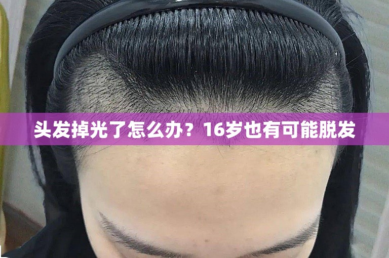 头发掉光了怎么办？16岁也有可能脱发