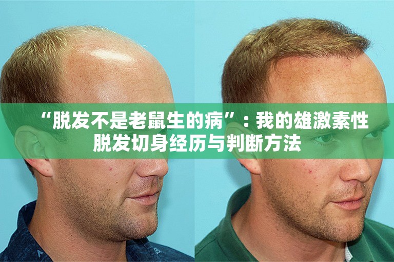 “脱发不是老鼠生的病”: 我的雄激素性脱发切身经历与判断方法