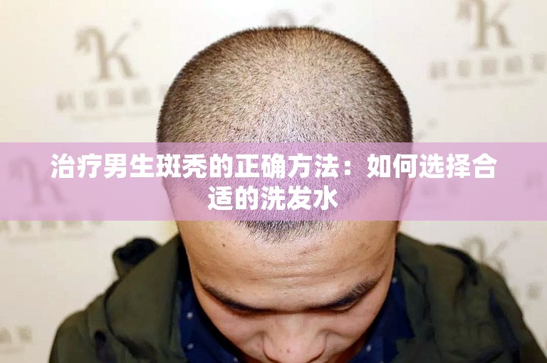 治疗男生斑秃的正确方法：如何选择合适的洗发水