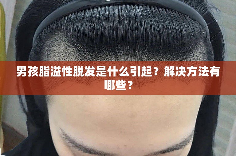 男孩脂溢性脱发是什么引起？解决方法有哪些？