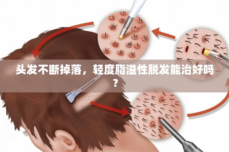 头发不断掉落，轻度脂溢性脱发能治好吗？