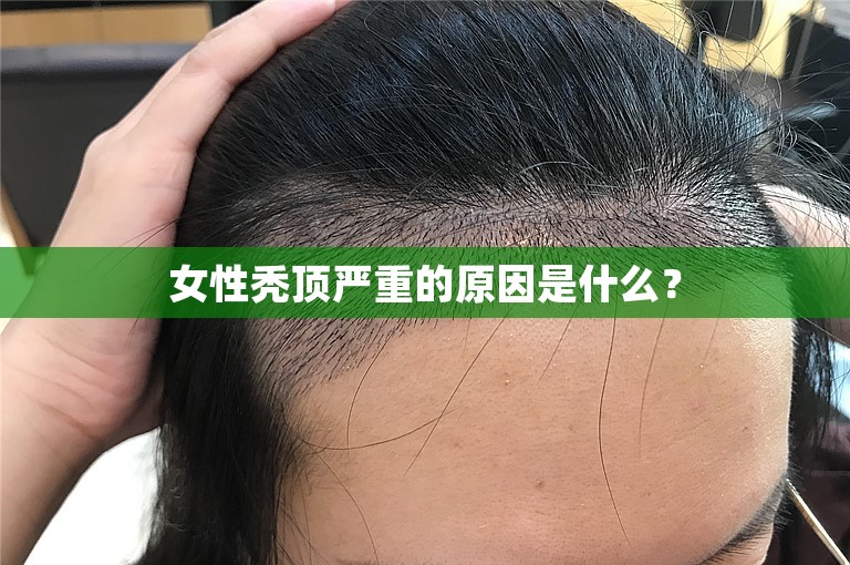 女性秃顶严重的原因是什么？