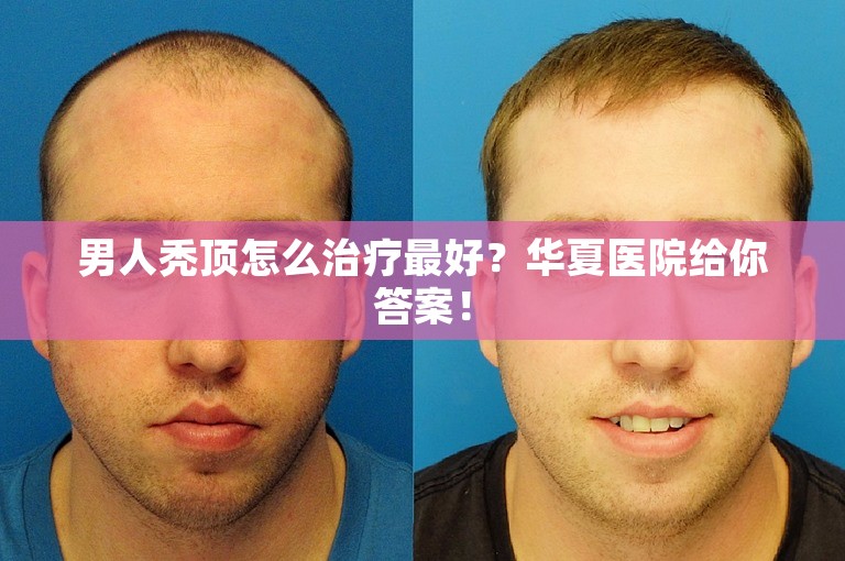 男人秃顶怎么治疗最好？华夏医院给你答案！