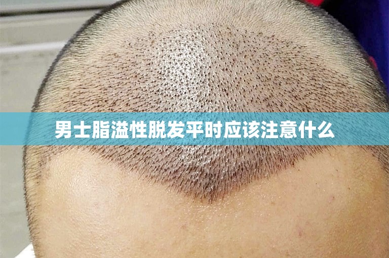 男士脂溢性脱发平时应该注意什么