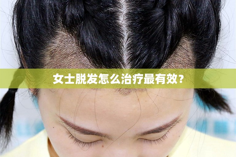 女士脱发怎么治疗最有效？