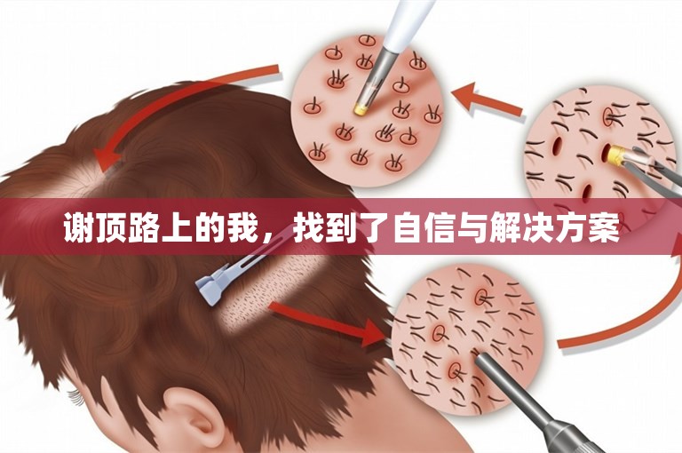 谢顶路上的我，找到了自信与解决方案