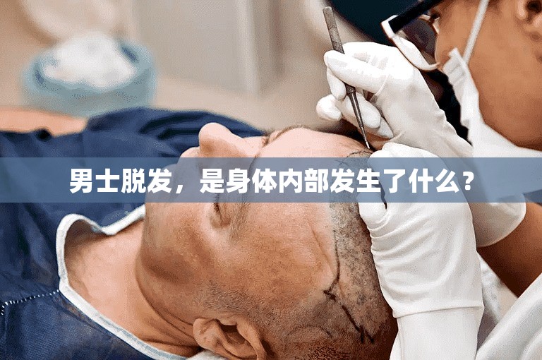 男士脱发，是身体内部发生了什么？