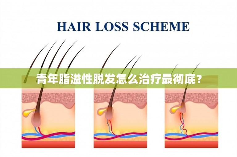 青年脂溢性脱发怎么治疗最彻底？