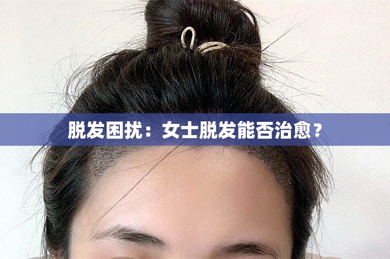 脱发困扰：女士脱发能否治愈？