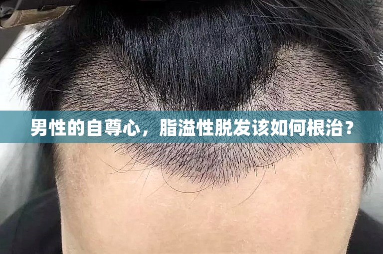 男性的自尊心，脂溢性脱发该如何根治？