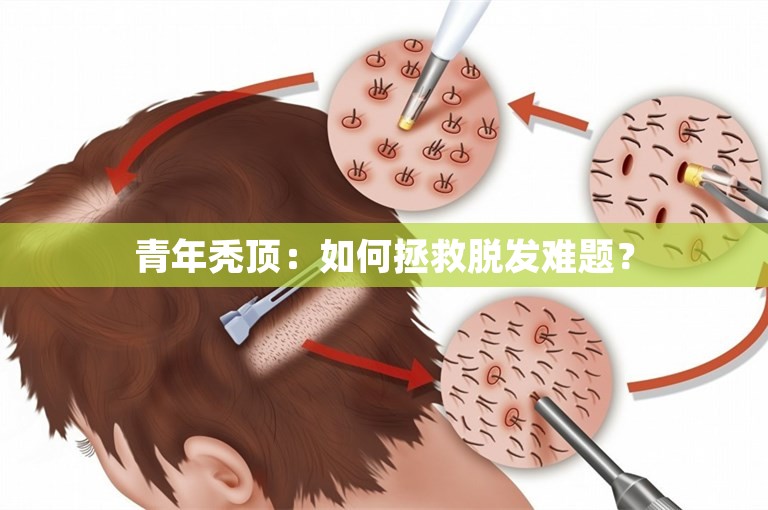 青年秃顶：如何拯救脱发难题？