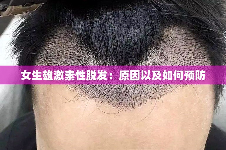 女生雄激素性脱发：原因以及如何预防