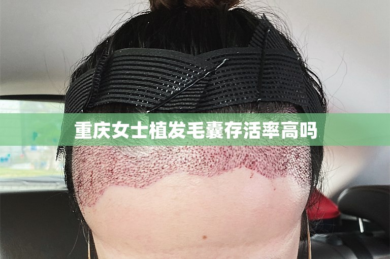 重庆女士植发毛囊存活率高吗