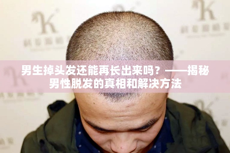 男生掉头发还能再长出来吗？——揭秘男性脱发的真相和解决方法