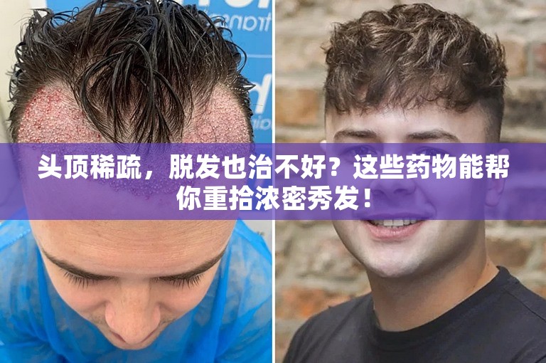 头顶稀疏，脱发也治不好？这些药物能帮你重拾浓密秀发！