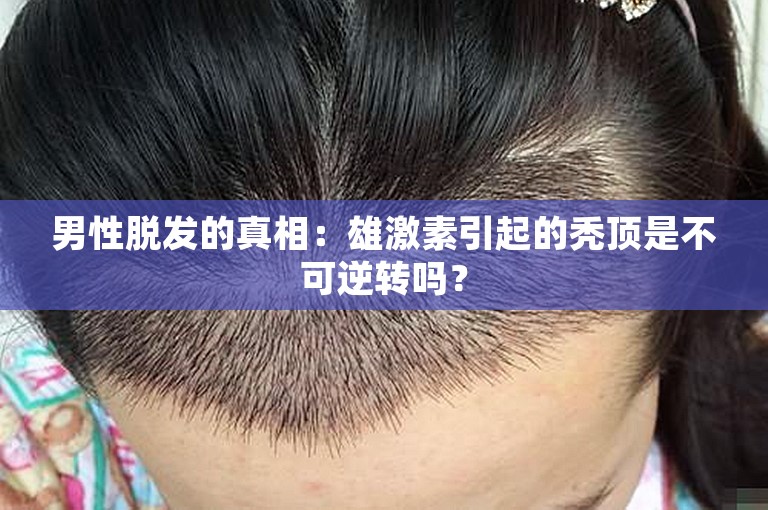 男性脱发的真相：雄激素引起的秃顶是不可逆转吗？