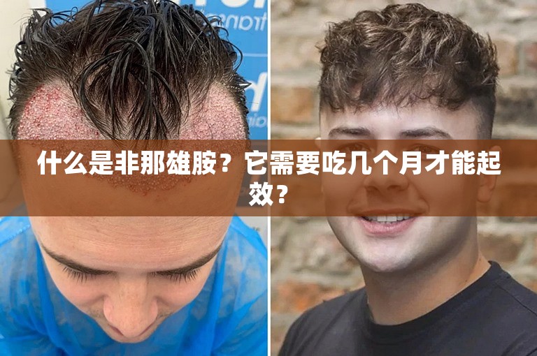 什么是非那雄胺？它需要吃几个月才能起效？