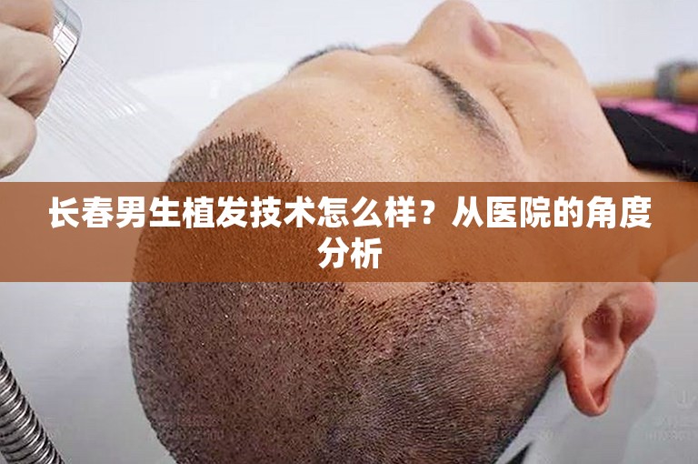 长春男生植发技术怎么样？从医院的角度分析