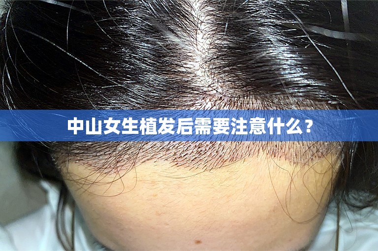 中山女生植发后需要注意什么？