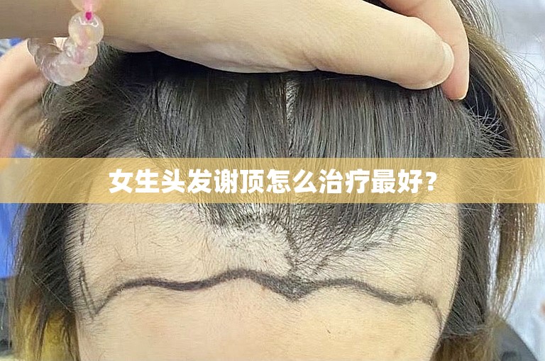 女生头发谢顶怎么治疗最好？