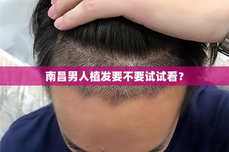 南昌男人植发要不要试试看？