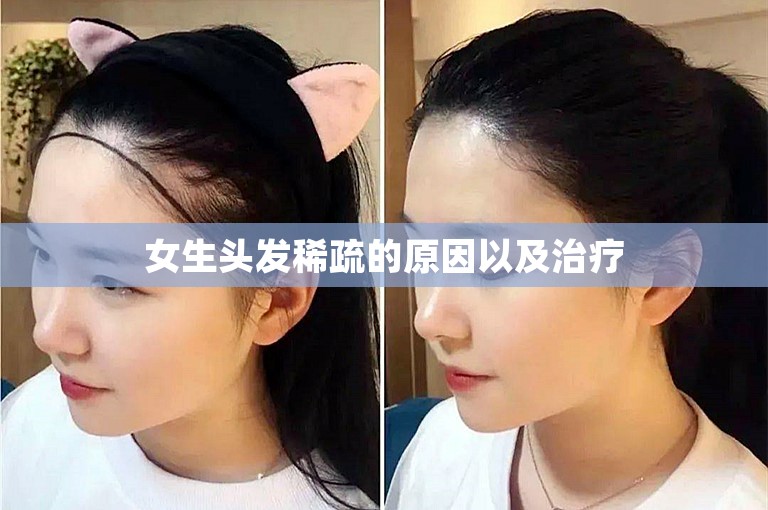 女生头发稀疏的原因以及治疗