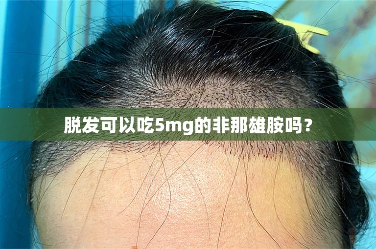 脱发可以吃5mg的非那雄胺吗？