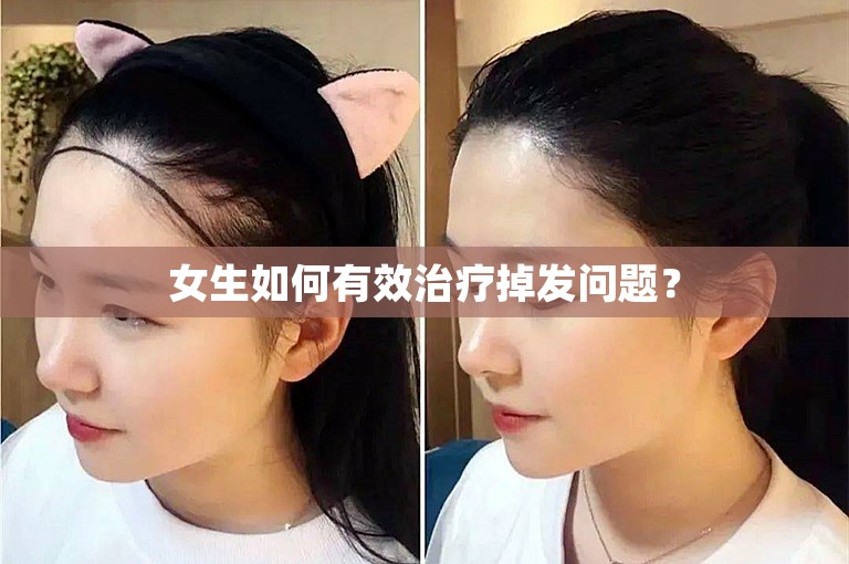 女生如何有效治疗掉发问题？