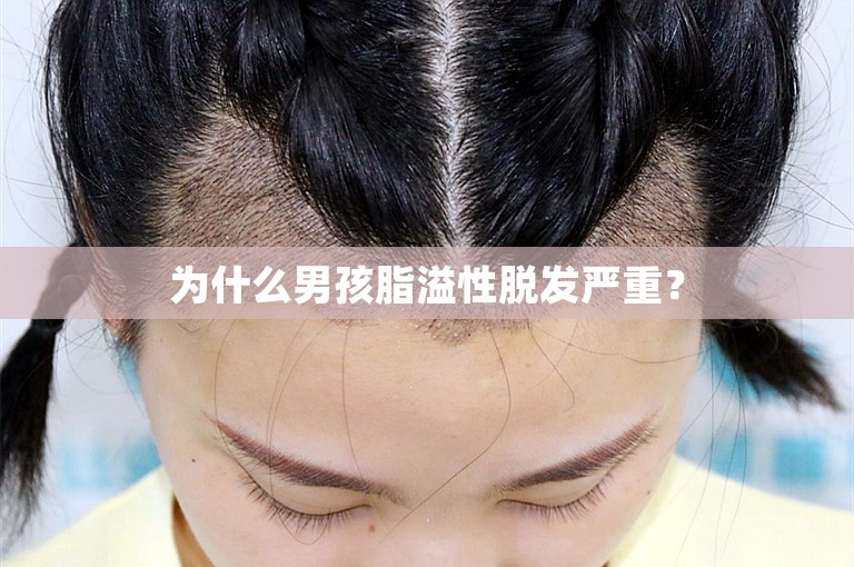 为什么男孩脂溢性脱发严重？