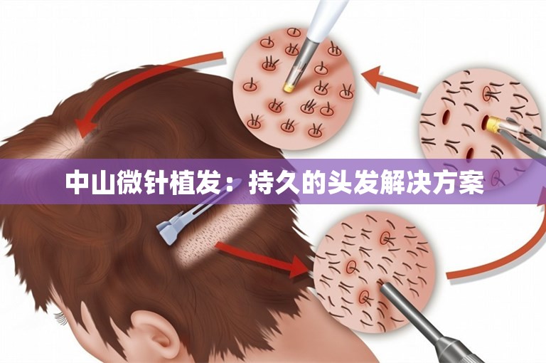 中山微针植发：持久的头发解决方案